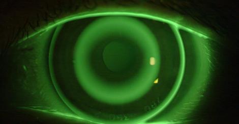 Curs Ortoqueratologia en astigmatisme